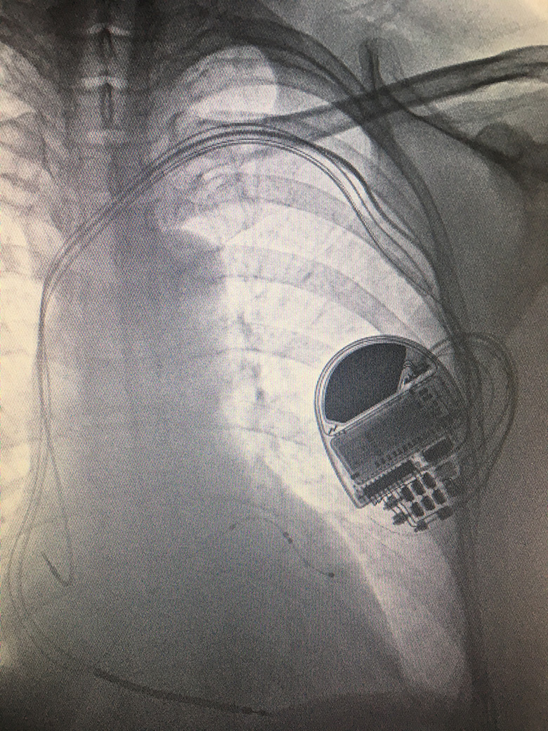 Implantable Cardioverter-Defibrillator (ICD) and cardiac resynchronisation therapy (CRT)