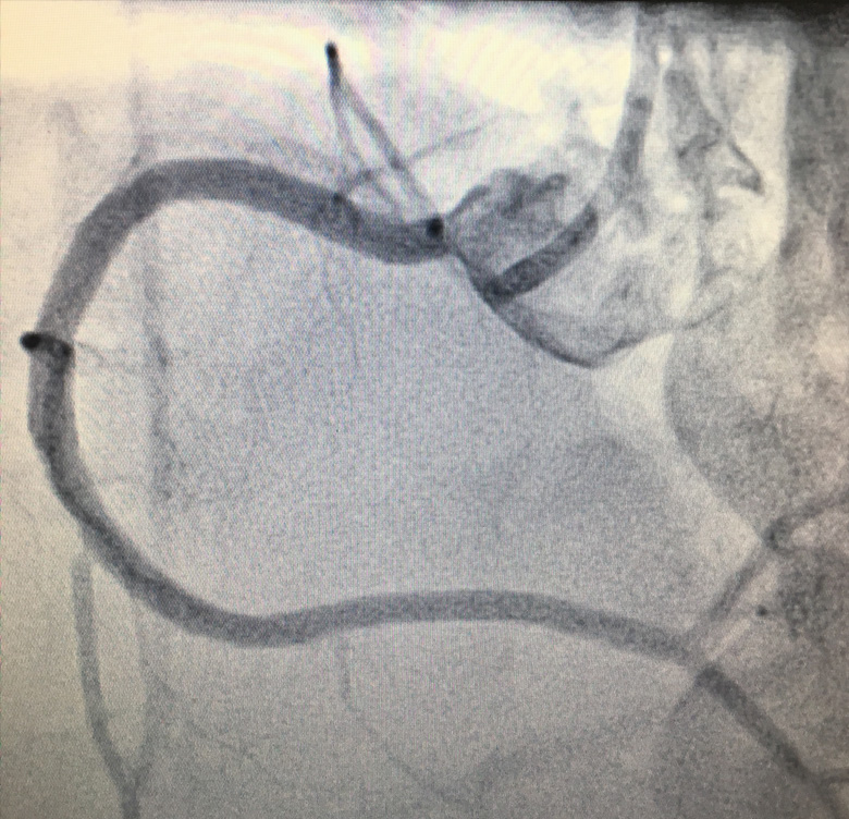 post PCI